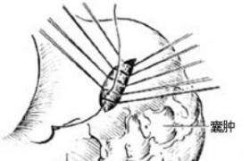胰腺囊腫