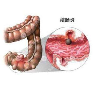 慢性結腸炎