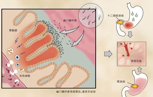 十二指腸損傷
