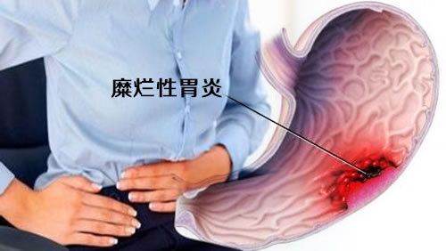 糜爛性胃炎