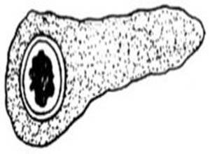 環(huán)形胰腺