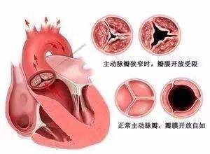 主動脈口狹窄