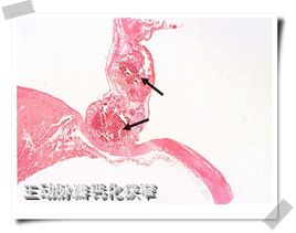 主動脈瓣鈣化