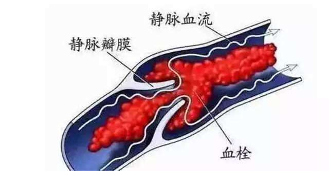 易栓癥