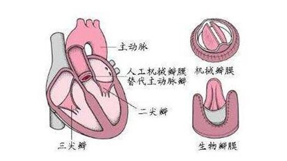 三尖瓣狹窄