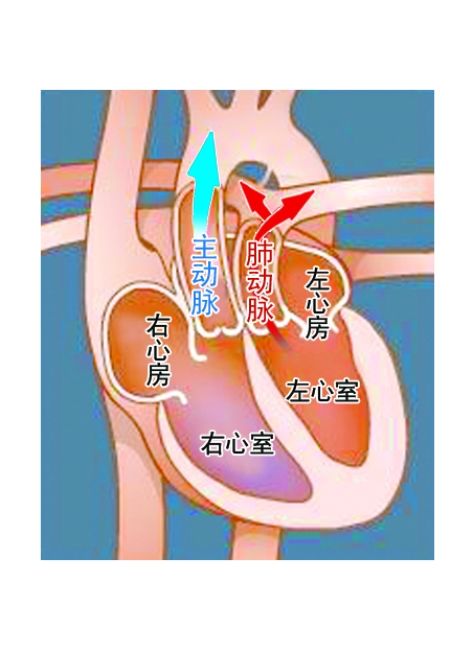 完全性大動脈轉位