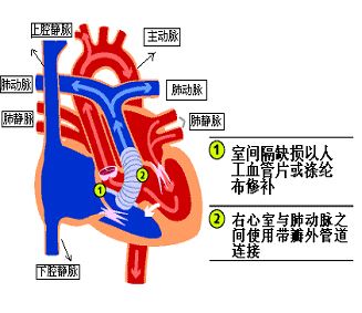 主-肺動脈間隔缺損