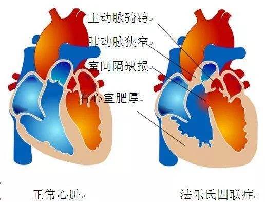 法洛四聯癥
