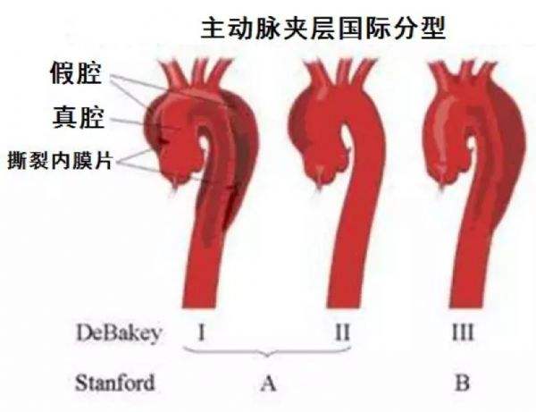 主動脈夾層