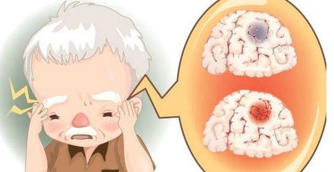 短暫性腦缺血發作