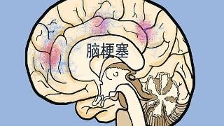 腦梗塞