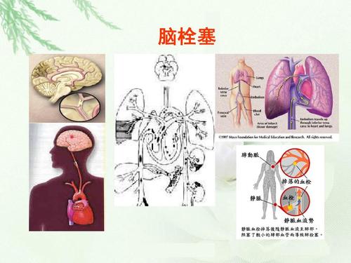 腦栓塞