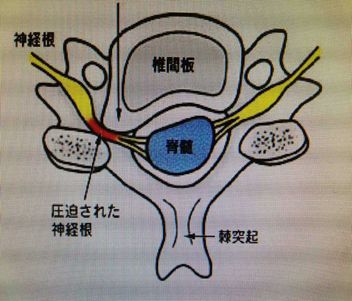 神經根型頸椎病