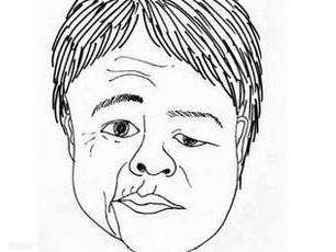 面肌痙攣