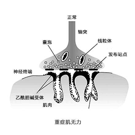 重癥肌無力