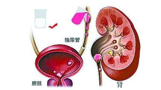 孤立腎