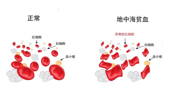地中海貧血
