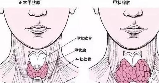 甲狀腺瘤