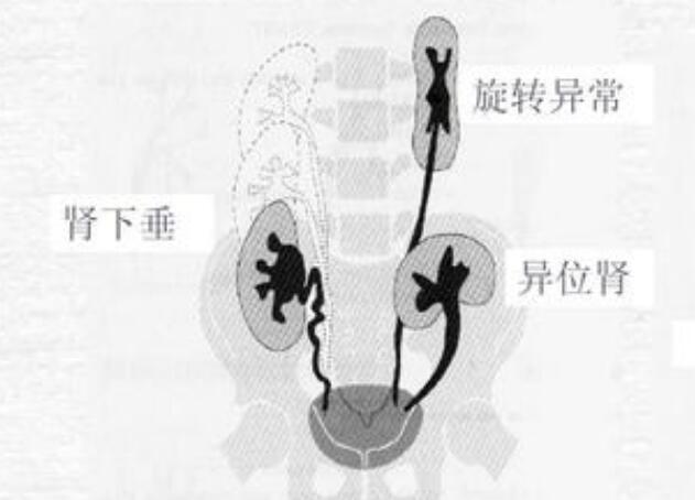腎下垂