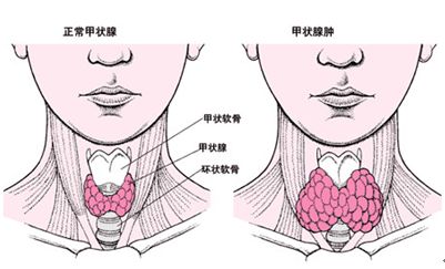 甲狀腺腫大