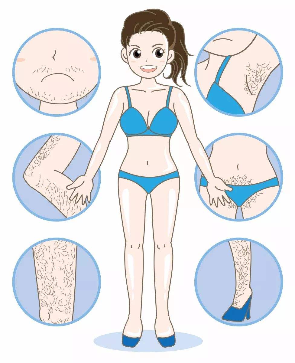 多毛癥