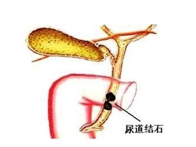 尿道結石
