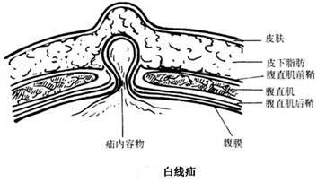 白線疝