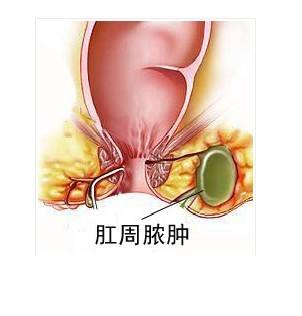 肛周膿腫