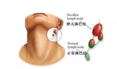 慢性淋巴結(jié)炎