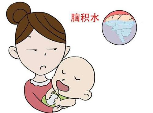 腦積水