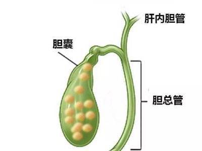 膽囊結(jié)石