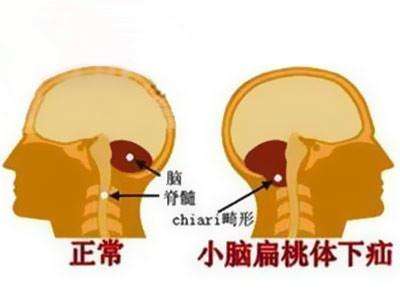 小腦扁桃體下疝