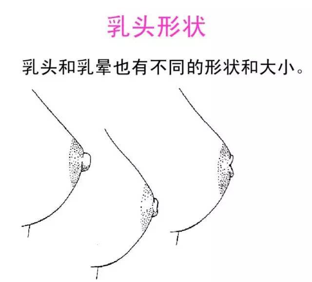 乳頭內陷