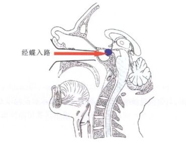 腦脊液鼻漏