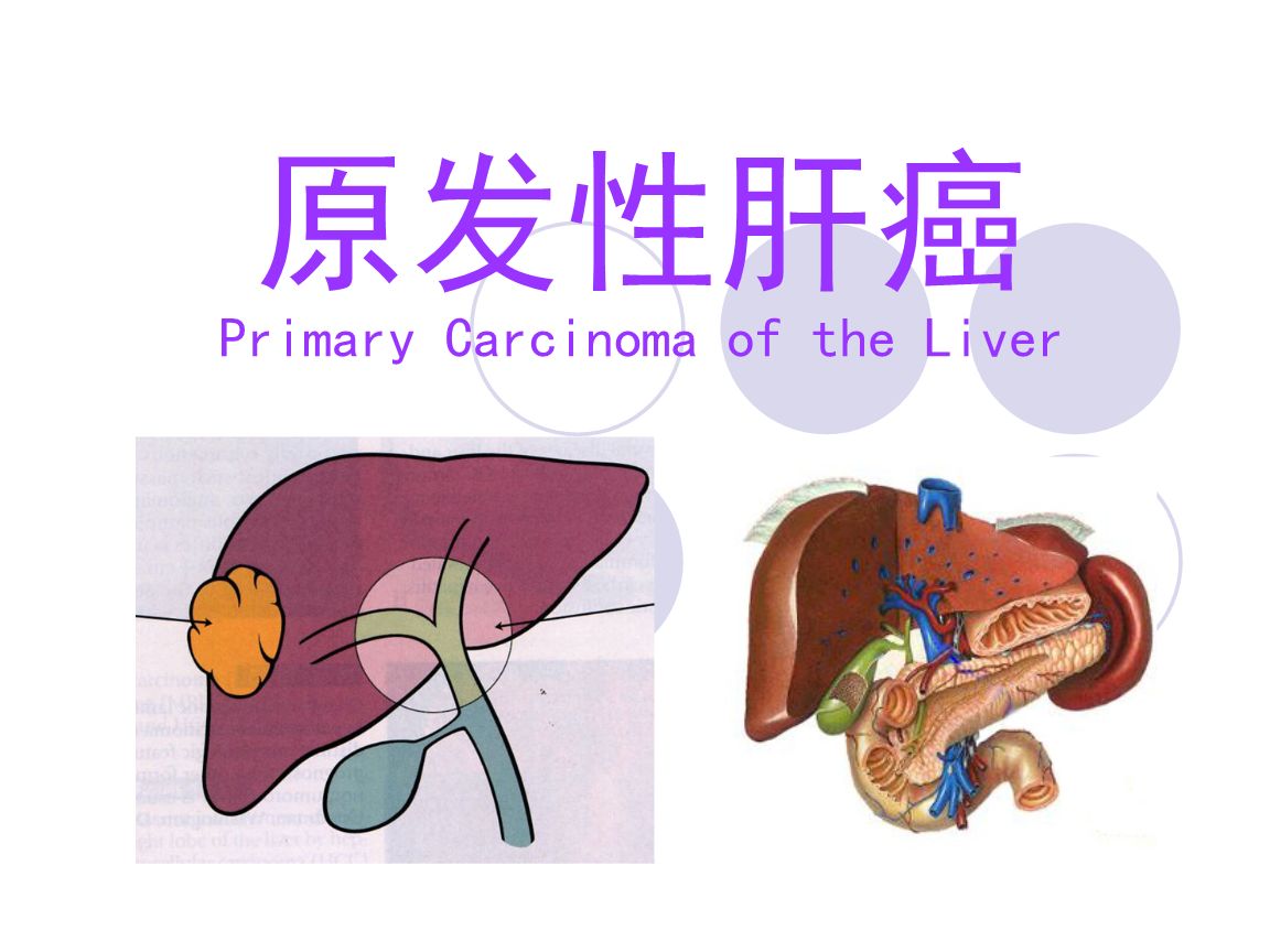原發性肝癌
