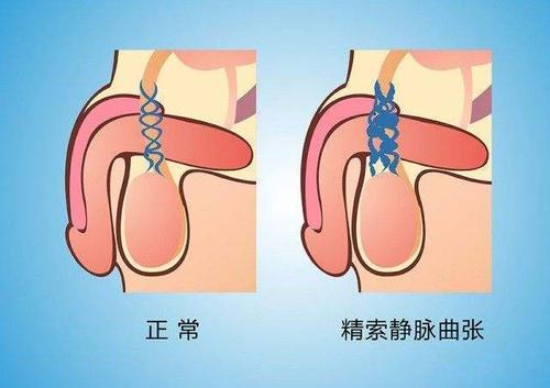 精索靜脈曲張