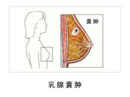 乳房囊腫