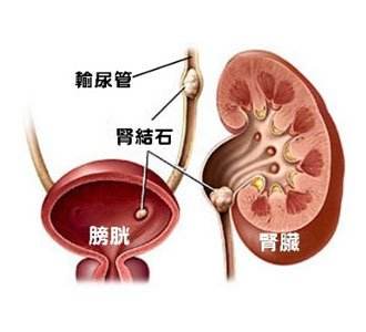 泌尿系結石