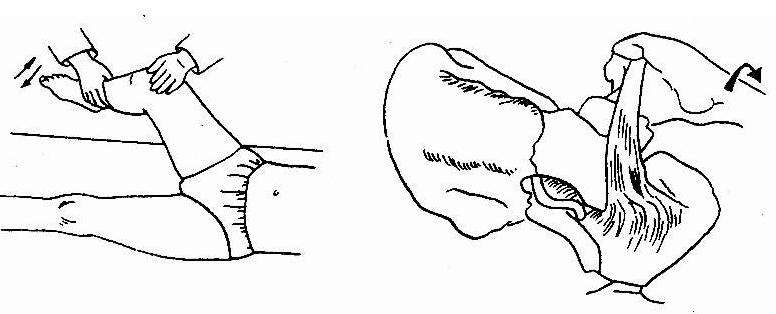 腹膜后血腫