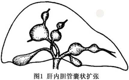 先天性膽管擴張癥