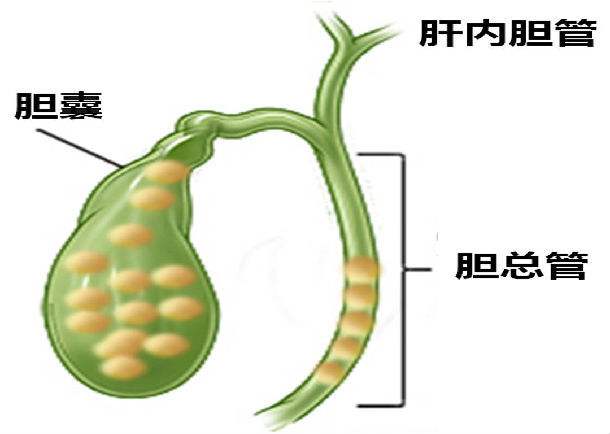 膽管結(jié)石