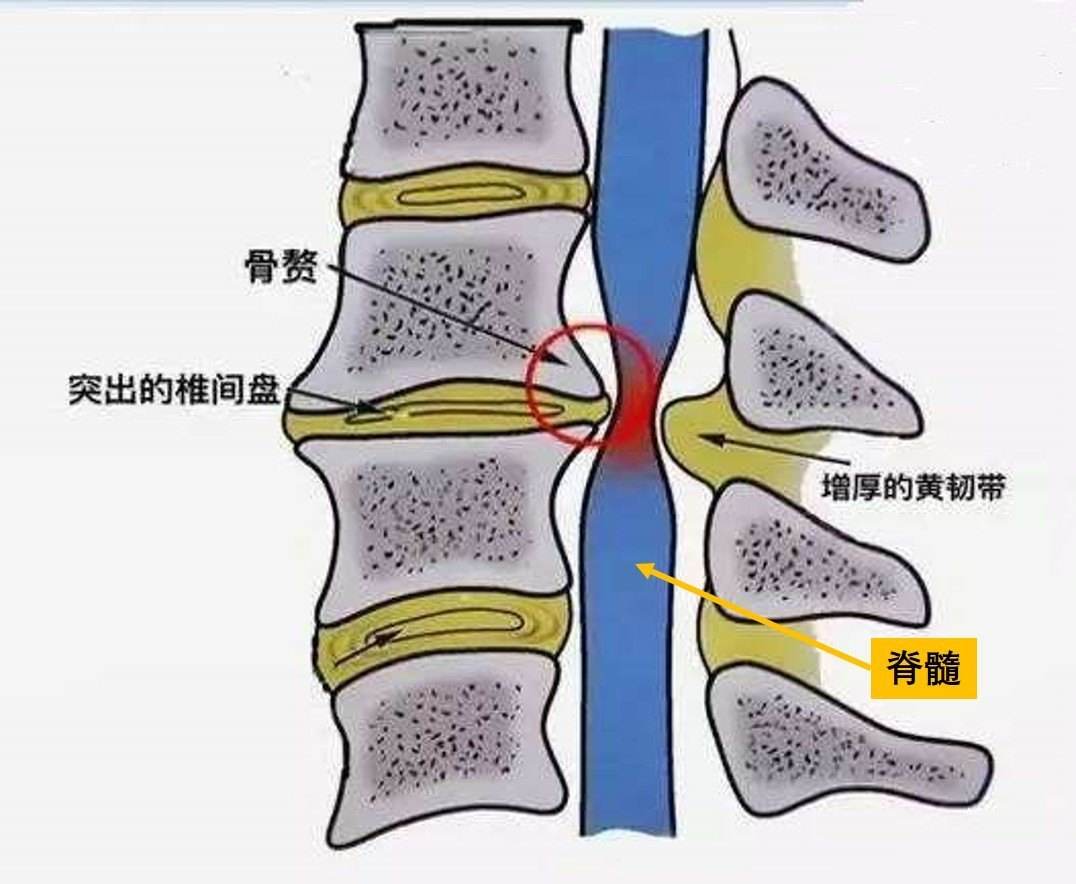 脊髓型頸椎病