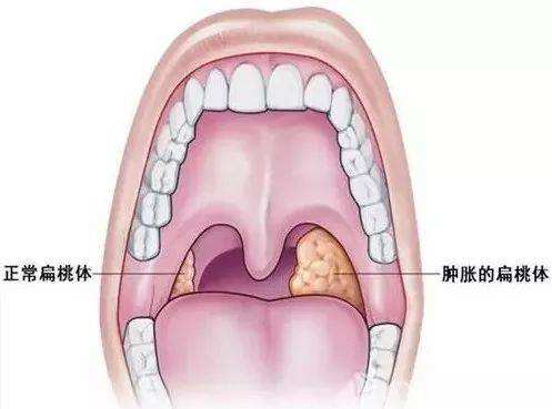 扁桃體周膿腫