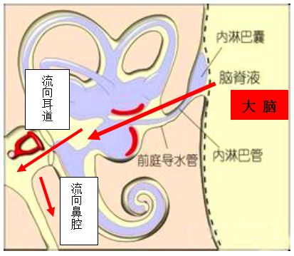 腦脊液耳漏