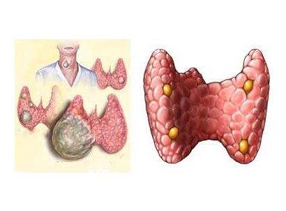 甲狀腺囊腫
