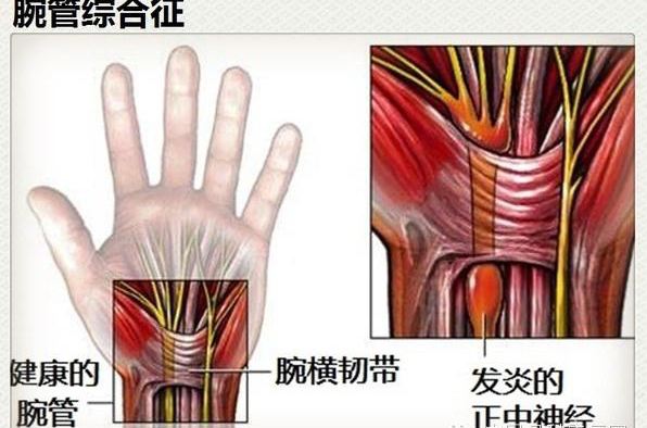 臀肌攣縮癥