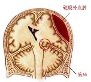 硬腦膜外血腫
