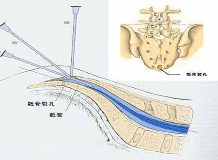 骶管囊腫