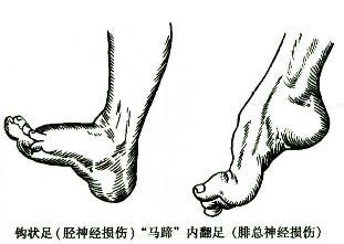 腓總神經(jīng)損傷