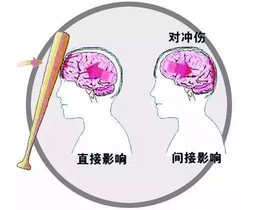 顱腦損傷